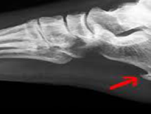 Patní ostruha a plantární fascitida