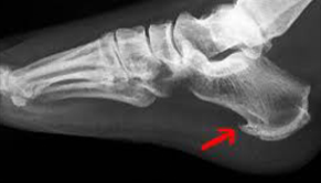 Patní ostruha a plantární fascitida